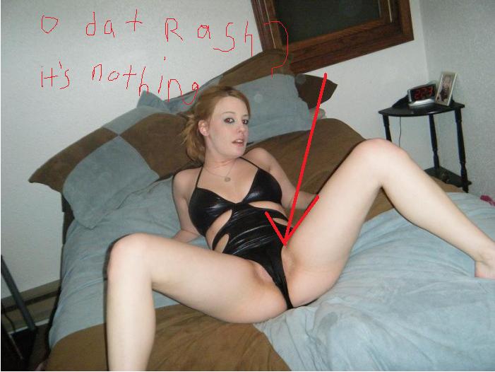 rash.jpg